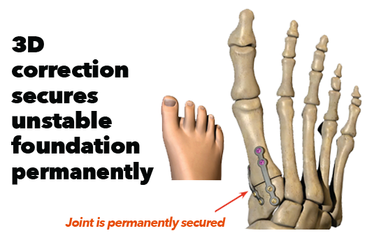Lapiplasty 3D Bunion Correction in Missouri & Illinois - Next Step Foot & Ankle Centers