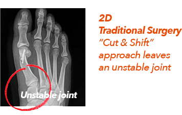 Lapiplasty 3D Bunion Correction in Missouri & Illinois - Next Step Foot & Ankle Centers